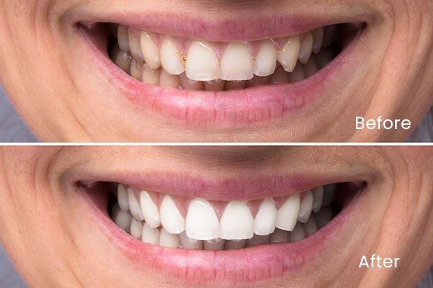 Teeth whitening Before and After Case 1