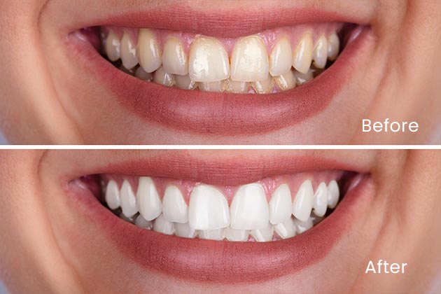 Teeth whitening Before and After Case 2