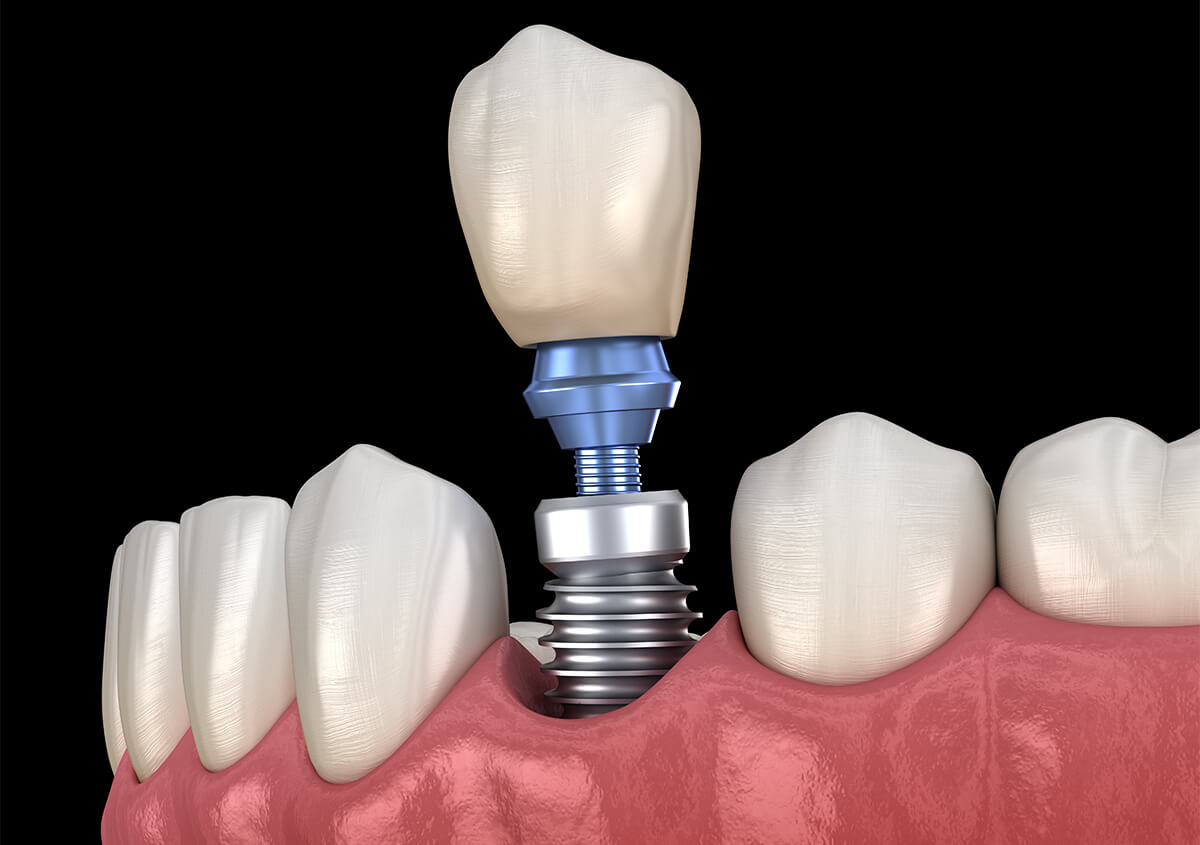 Dental Implants Treatment in Walnut Creek California Area