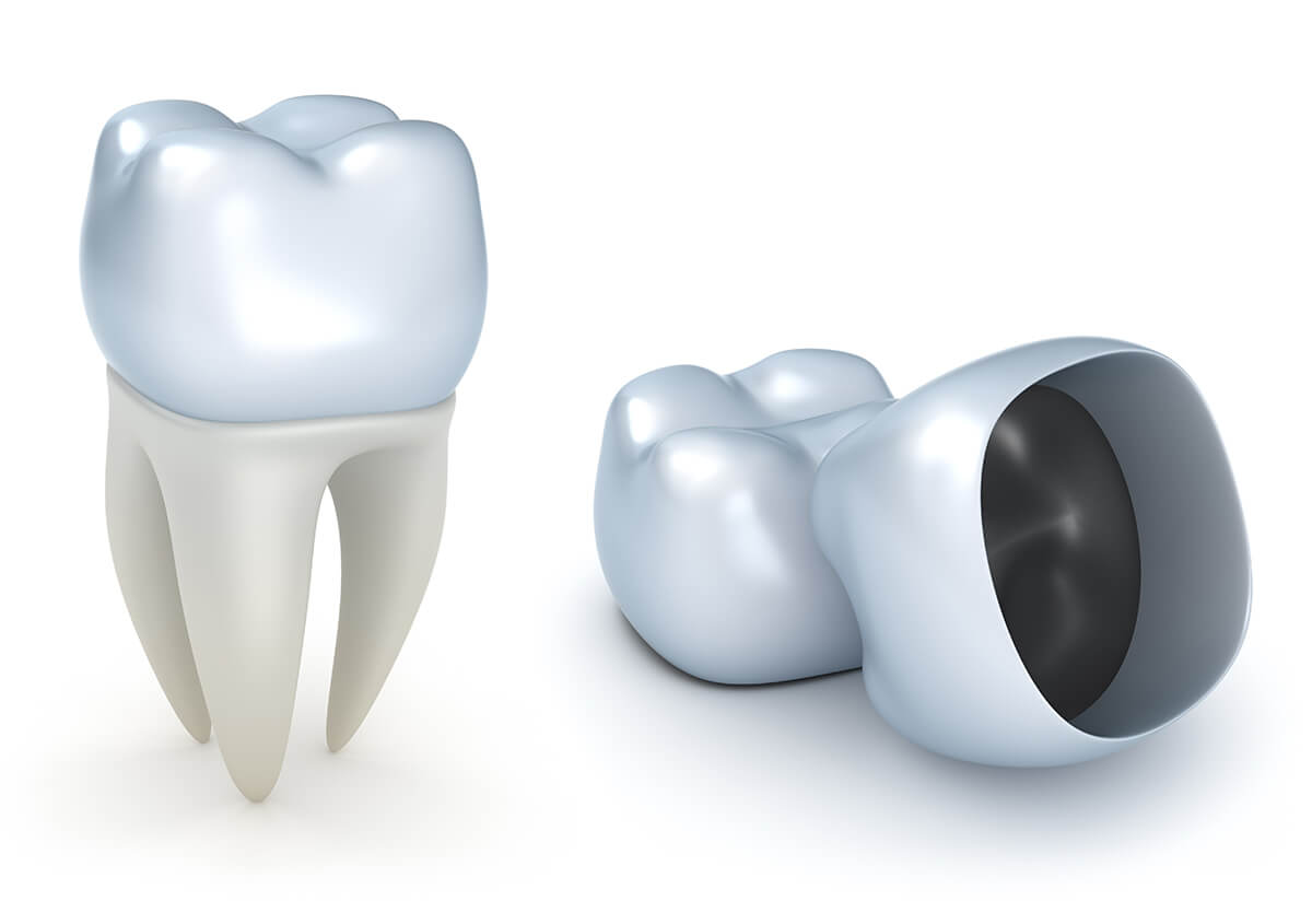 Tooth Colored Crowns in Walnut Creek California Area