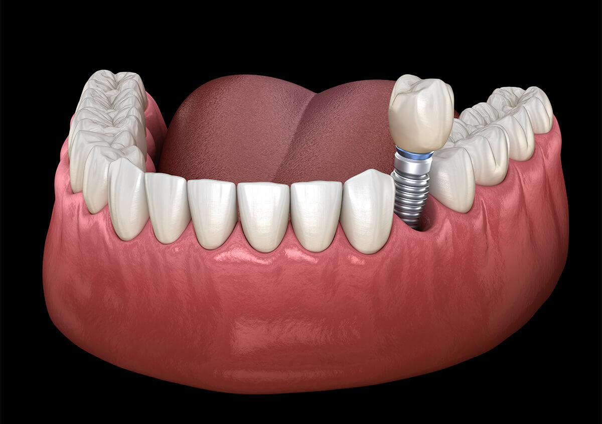 Are Dental Implants Painful in Walnut Creek CA Area